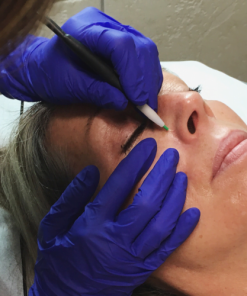 Traitement de thermocoagulation